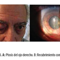 Figura 1. A: Ptosis del ojo derecho. B: Recubrimiento conjuntival.