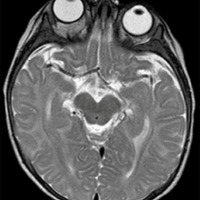 Figura 2. RMN T2 en paciente de 9 meses de edad con hemangioma orbitario derecho.