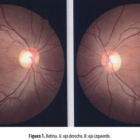 Manejo de neurocisticercosis en hemianopsia homónima