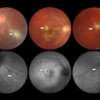 Figura 1. Patrones de autofluorescencia inicial en pacientes con diagnóstico clínico de retinitis por toxoplasmosis. Caso 4 (izquierda): retinitis con vasculitis en sector nasal inferior de ojo derecho. A la AFF se observa patrón de hiperautofluorescencia poco definida de bordes difusos y dos puntos hipoautofluorescentes correspondientes a sectores de hiperplasia pigmentaria. Caso 7 (centro): foco de retinitis yuxtafoveal y lesiones punteadas en área macular. A la AFF se observa lesión hiperautofluorescente de bordes netos con moteado hipoautofluorescente en su interior. Las lesiones punteadas descriptas no se visualizan con este método. Caso 19 (derecha): retinitis adyacente a cicatriz retinocoroidea en sector nasal superior de ojo derecho. A la AFF no se evidencian alteraciones en el sector correspondiente al foco de retinitis (isoautofluorescencia). Las lesiones hipoautofluorescentes se corresponden con las cicatrices retinocoroideas.