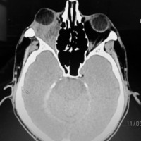 Histiocitoma fibroso maligno 
