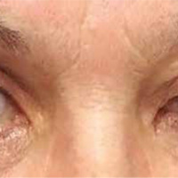 Schwannoma orbitario: causa infrecuente de estrabismo secundario
