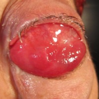 Figura 5. Masa tumoral de rápido crecimiento posterior a toma de biopsia incisional.