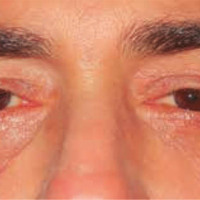 Tres semanas después de tratamiento quirúrgico de blefaroplastia inferior con reposición grasa y blefaroplastia superior.