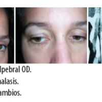 Figura 8. Ptosis palpebral OD. Figura 9. Blefarochalasis. <br />
Figura 9. Blefarochalasis<br />
Figura 10. TC sin cambios.