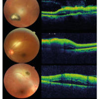 Figura 2. Casos 37, 30 y 1. Focos de retinitis con desprendimiento de neuroepitelio. Hialoides parcial o totalmente adherida, engrosamiento hiperreflectivo de la retina interna e imagen hiporreflectiva subretinal.
