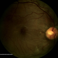 Figura 19. RG a color OD. Se observa región macular sin sobreelevaciones o edema macular.