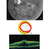 Figura 2. a) Foto libre de rojo muestra la presencia de una anillo anular fibroso sobre el área macular. Los vasos perifoveales se encuentran traccionados por la membrana. b y c) TCO revela la presencia de múltiples quistes intrarretinales compatibles con la presencia de un edema macular quístico. La desorganización de la microarquitectura retinal es evidente y la formación del vector vertical interno, visible. El tejido macular se encuentra prolapsado<br />
a través del anillo fibroso. Espesor macular: 612 u. (Si hubiera posibilidad de ver estudios con TCO de mayor definición, que hoy son el estándar de<br />
seguimiento, sería bueno pero hay zonas o establecimientos donde no está disponible)