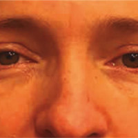 A las 6 semanas luego de reposición grasa más blefaroplastia superior.