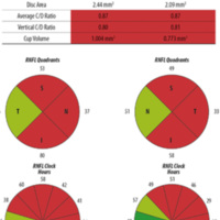 Figura 3. Los datos de la tomografía de coherencia óptica, donde se constata la disminución generalizada de capas de fibras nerviosas.