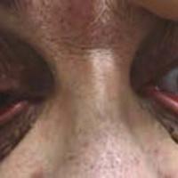 Figura 4. Paciente masculino de IMC mayor de 30 con hiperlaxitud palpebral, ectropión y conjuntivitis papilar crónica. 