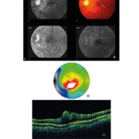 Figura 1. a) Fotografía color y libre de rojo revelan la presencia de una MER en el área macular que produce tracción sobre la arcada vascular inferior. La AF muestra escape de colorante en los tiempos tardíos. b) TCO muestra aumento del espesor retinal por debajo del punto de fijación. Espesor macular: 535 u. c) TCO revela el pinzamiento de las capas internas de la retina ocasionando el prolapso macular anterior.
