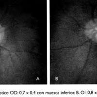 Fig. 2. Caso I .A Disco Optico OD: 0,7 x 0,4 con muesca inferior. B. 01: 0,8 x 0,5.