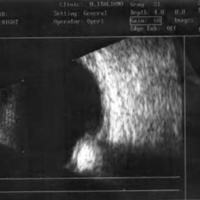Figura 2. Ecografía ocular durante el proceso de isquemia del<br />
segmento anterior