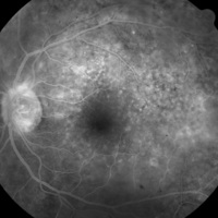 Figura 5. La misma paciente de la figura 4. En la angiografía del OI se observan múltiples puntos hiperfluorescentes por efecto ventana y sobre el sector temporal, áreas hiperfluorescentes por tinción del infiltrado subretinal. Se destacan múltiples puntos hipofluorescentes por bloqueo, por acumulación de células del EPR. Se puede notar además una hiperfluorescencia del disco óptico.
