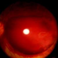 Figura 1. Hemorragia prerretinal en sector nasal de ojo derecho.