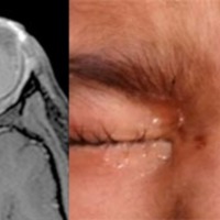 Figura 5. A) RMN T1 en paciente de 3 años de edad con diagnóstico de retinoblastoma extraocular. B) Imagen exterior del paciente.