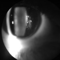 Amiloidosis vítrea en un caso de<br /><br />
polineuropatía amiloidótica familiar (PAF)<br /><br />
debido a una mutación poco habitual en el<br /><br />
gen de la transtirretina (Ala36Pro)