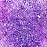Figura 2. HyE 100x. Proliferación neoplásica de estirpe fibroconectiva, colagenizada con patrón de crecimiento estoriforme.