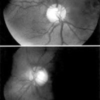 Fig. 8. Caso 3.0D, C/D 0,6 con muesca inferior en ojo derecho.