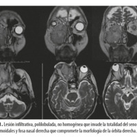 Figura 1. Lesión infiltrativa, polilobulada, no homogénea que invade la totalidad del seno maxilar, celdillas etmoidales y fosa nasal derecha que compromete la morfología de la órbita derecha.