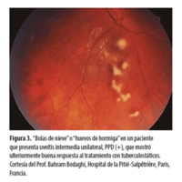 Figura 3. “Bolas de nieve” o “huevos de hormiga” en un paciente que presenta uveítis intermedia unilateral, PPD (+), que mostró ulteriormente buena respuesta al tratamiento con tuberculostáticos. Cortesía del Prof. Bahram Bodaghi, Hospital de la Pitié-Salpêtrière, Paris, Francia.