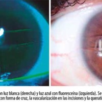 Un caso de astigmatismo irregular posqueratotomía radial: adaptación de lentes esclerales