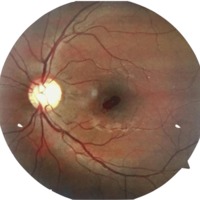 Figura 1. Retinografía con evidencia de hemorragia macular de bordes definidos.