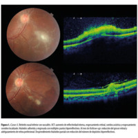 Figura 1. Caso 5. Retinitis nasal inferior con vasculitis. OCT: aumento de reflectividad interna, engrosamiento retinal, sombra acústica y engrosamiento coroideo localizado. Hialoides adherida y engrosada con múltiples puntos hiperreflectivos. Al mes de follow-up: reducción del grosor retinal y adelgazamiento de retina perilesional. Desprendimiento hialoideo parcial con reducción del número de depósitos hiperreflectivos.