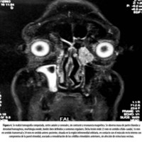 Figura 4. Se realizó tomografía computada cortes axiales y coronales, sin contraste y resonancia magnética. Se observa masa de partes blandas y densidad homogénea, morfología ovoidea, bordes bien definidos y contornos regulares. Dicha lesión mide 23 mm en sentido céfalo-caudal, 16 mm en sentido transversal y 24 mm en sentido antero-posterior, situada en la región inferomedial orbitaria, en contacto con el músculo recto interno con compromiso de la pared etmoidal, asociado a remodelación de las celdillas etmoidales anteriores, sin afección de estructuras vecinas.
