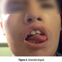 Figura 4. Anomalía lingual.