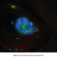 Figura 6. Cuadro en resolución. Ojo derecho sin presencia de tinción.