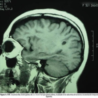 Figura 4. RMN. Secuencia flair, lesión quística de 2 x 1.4 x 0.9 cm que genera edema, localizado en la subcorteza de la tercera circunvolución temporal<br />
izquierda.