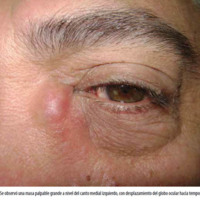 Figura 1. Se observó una masa palpable grande a nivel del canto medial izquierdo, con desplazamiento del globo ocular hacia temporal superior.
