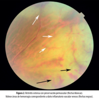Figura 2. Retinitis extensa con preservación perivascular (flechas blancas). Nótese áreas de hemorragia correspondiente a daño inflamatorio vascular venoso (flechas negras).