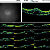 Figura 9. OCT macular OD a los 10 días del posquirúrgico. Se observa una leve disminución del EM (656 μm) con respecto del prequirúrgico (EM 681 μm).