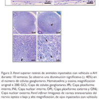 Figura 3. Panel superior: retinas de animales inyectados con vehículo o AH durante 10 semanas. Se observa una disminución significativa (-z- 40%) en el número de células ganglionares. Hematoxilina y eosina, magnificación original x 200. GCL: Capa de células ganglionares, IPL: Capa plexiforme interna, INL: Capa nuclear interna, OPL: Capa plexiforme externa y ONL:<br />
Capa nuclear externa. Panel inferior: Imágenes de cortes transversales del nervio óptico a baja y alta magnificación, de ojos inyectados con vehículo (A, C) y ojos tratados con AH (B, D) durante 10 semanas. En (C) se observan axones uniformes (flechas), redondos y en grupos compactos<br />
que conforman un nervio óptico sano. En el nervio óptico del ojo tratado con AH (B) se observa un área de menor tinción (flecha) que indican la alteración del nervio. A mayor magnificación (D) se observa menor densidad de fibras. Los axones del nervio tratado perdieron su estructura circular y se observa distorsión, distensión (flechas) y disminución en el número. Azul de toluidina.