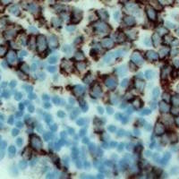 Figura 4. b) Técnica de inmunohistoquímica para linfocitos B CD20+.