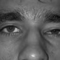 Ptosis adquirida y recurrente como<br /><br />
manifestación de infiltración amiloidea del<br /><br />
músculo elevador del párpado
