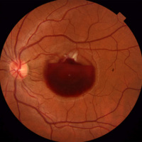 Figura 1. Hemorragia subhialoidea de dos diámetros y medio de papila que cubre por completo el área macular, con distorsión en el trayecto vascular superior. <br />
En el archivo JPG la foto que corresponde es la inferior la cual termina en Q:31 (HS) 
