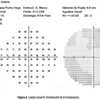 Figura 6. Campo visual OI. Disminución de la hemianopsia.
