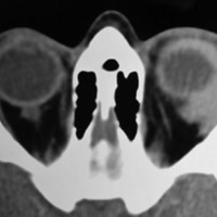 Figura 2. TC axial. Imagen levemente hiperdensa en órbita ántero-lateral, bien definida, de bordes levemente irregulares, homogénea, no invade globo ocular ni invade hueso.<br />
