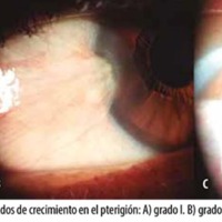 Uso de carboximetilcelulosa y hialuronato de sodio/condroitín sulfato en postoperatorio de cirugía de pterigión primario manejado con antibióticos y esteroides tópicos más ácido ascórbico