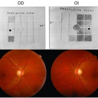 Figura 1. Tomografía de doble frecuencia (FDT) de primera consulta donde se evidencia hemianopsia temporal en OD y disminución de la sensibilidad temporal en OI. Retinografías color con discreta palidez temporal de los discos ópticos.