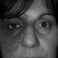Melanoma orbitario primario asociado con melanocitosis oculodérmica y revisión bibliográfica