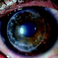 Figura 5. La córnea a los 120 días postoperatorios<br />
de la segunda cirugía. El injerto está transparente<br />
con buena agudeza visual corregida.