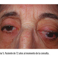 Tumor fibroso solitario maligno de órbita: dos casos