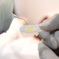 Figura 3. Embebido de la lente de contacto en distintas soluciones de riboflavina.