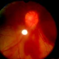 Figura 3. Hemorragia prerretinal macular totalmente reabsorbida con persistencia en lado nasal, ojo derecho.