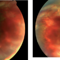 Masa intraocular e inflamación periocular: forma atípica de presentación de melanoma coroideo